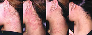Eczema/Atopic Dermatitis