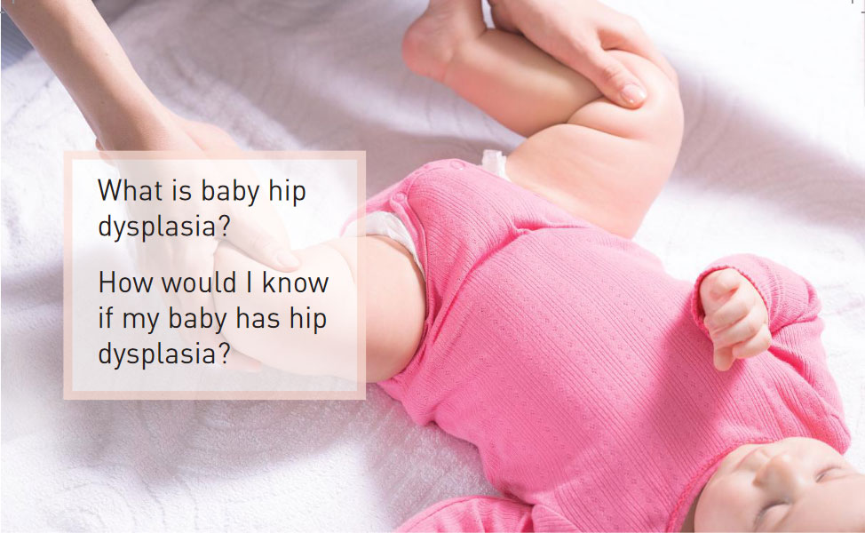 Hip Dysplasia in Babies