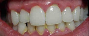 Importance of Clean Teeth 02