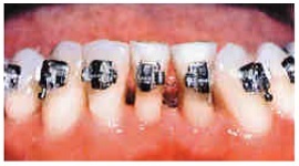 Importance of Clean Teeth 11