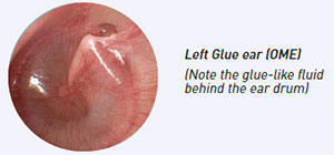Glue Ear in Children