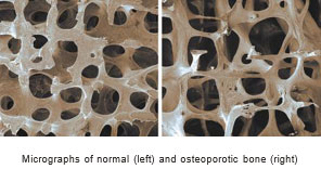 Osteoporosis and Bone Densitometry