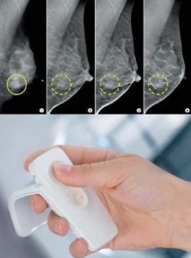 Reshaping the Mammography Experience 03