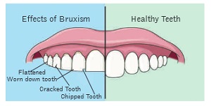 Teeth Grinding 02
