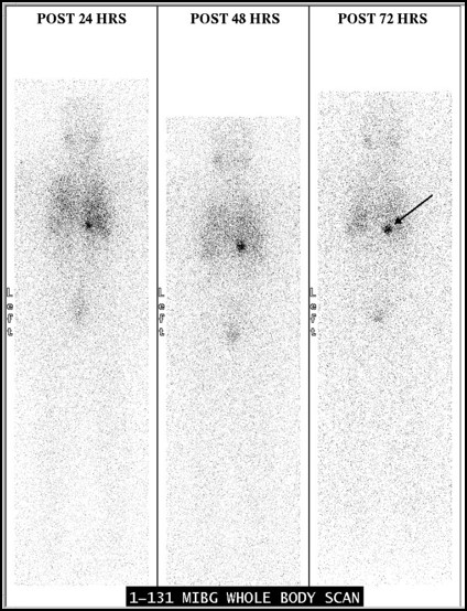 131-MIBG Scintigraphy In Pheochromocytoma 01