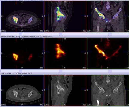 A case of polystotic pagets with dorsal vertebral tubercular spondylodiscitis on whole body spect-ct skeletal scintigraphy 02