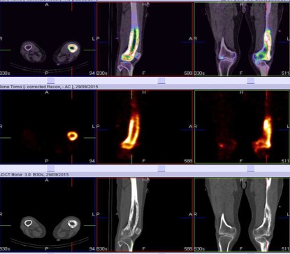 A case of polystotic pagets with dorsal vertebral tubercular spondylodiscitis on whole body spect-ct skeletal scintigraphy 03