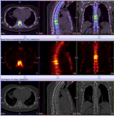 A case of polystotic pagets with dorsal vertebral tubercular spondylodiscitis on whole body spect-ct skeletal scintigraphy 04