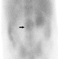 A case of polystotic pagets with dorsal vertebral tubercular spondylodiscitis on whole body spect-ct skeletal scintigraphy 06