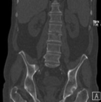A case of polystotic pagets with dorsal vertebral tubercular spondylodiscitis on whole body spect-ct skeletal scintigraphy 08