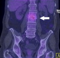 A case of polystotic pagets with dorsal vertebral tubercular spondylodiscitis on whole body spect-ct skeletal scintigraphy 09