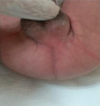 A rare case of Imperforate Anus Surgery performed in 36 hours old baby weighing 1.6 kg by Dr. Wissam Altamr, Specialist, Paediatric Surgery at NMC Royal Hospital, Sharjah 