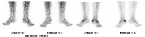 Additional benefit of bone spect-ct in investigating heel pain (a case of left foot achilles tendonitis) 02