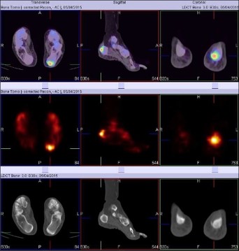 Additional benefit of bone spect-ct in investigating heel pain (a case of left foot achilles tendonitis) 03