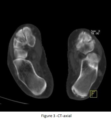 Additional benefit of bone spect-ct in investigating heel pain (a case of left foot achilles tendonitis) 04