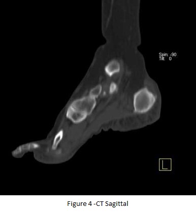 Additional benefit of bone spect-ct in investigating heel pain (a case of left foot achilles tendonitis) 05