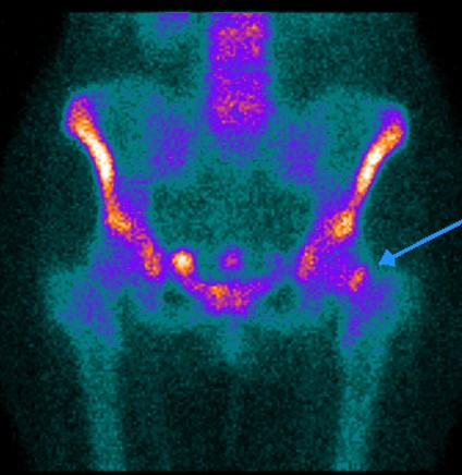 Bone scanning in the detection of occult fractures 02
