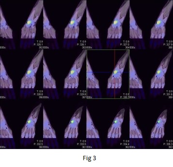 Bone scanning in the detection of occult fractures 05