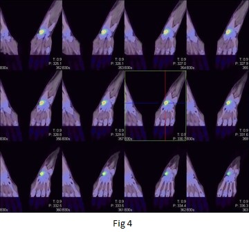 Bone scanning in the detection of occult fractures 06