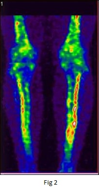 Bone scintigraphy in shin splints, Scintigraphy stress fracture patterns & classification of medial tibial stress syndrome