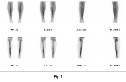 Bone scintigraphy in shin splints, Scintigraphy stress fracture patterns & classification of medial tibial stress syndrome