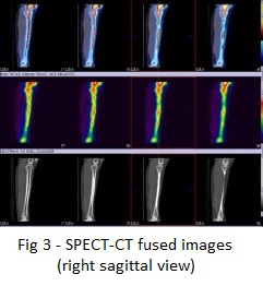 Bone Scintigraphy In Tibial Stress Syndrome Or Shin Splints 022