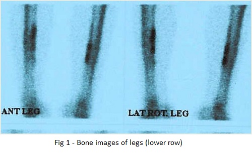 Bone Scintigraphy In Tibial Stress Syndrome Or Shin Splints 029