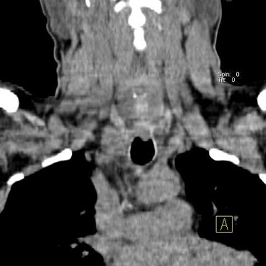Case of primary hyperparathyroidism with minimal symptoms & maximum findings 04