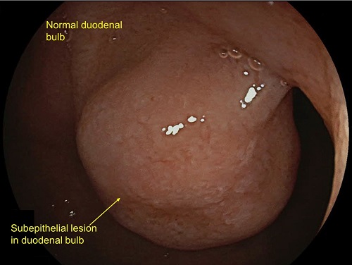 Duodenal bulb ectopic pancreas diagnosed by Endoscopic Ultrasound (EUS) guided Biopsy 02