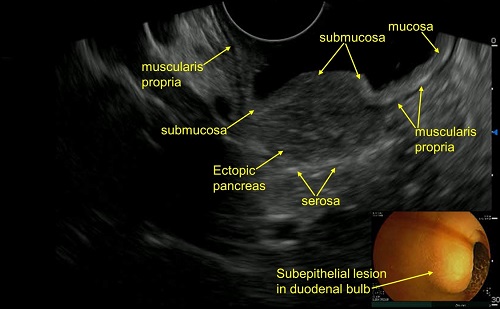 Duodenal bulb ectopic pancreas diagnosed by Endoscopic Ultrasound (EUS) guided Biopsy 03