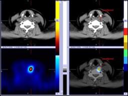 Ectopic Parathyroid Adenoma in Neck by Tc-99m Sestamibi SPECT/CT Localization” by Dr Shekar Shikare, HOD & Consultant, Nuclear Medicine, NMC Royal Hospital Sharjah 