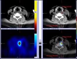 Ectopic Parathyroid Adenoma in Neck by Tc-99m Sestamibi SPECT/CT Localization” by Dr Shekar Shikare, HOD & Consultant, Nuclear Medicine, NMC Royal Hospital Sharjah 