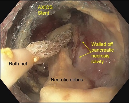 Endoscopic necrosectomy of large walled off pancreatic necrosis (pseudocyst with solid necrosis)” by Dr Piyush Somani, Specialist Gastroenterology, Al Zahra Hospital Sharjah