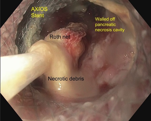 Endoscopic necrosectomy of large walled off pancreatic necrosis (pseudocyst with solid necrosis)” by Dr Piyush Somani, Specialist Gastroenterology, Al Zahra Hospital Sharjah