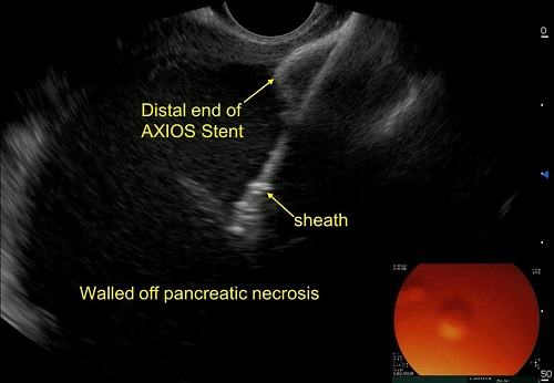 Endoscopic Ultrasound guided drainage of large walled off pancreatic necrosis (Pseudocyst with solid necrosis) with metallic AXIOS stent 02