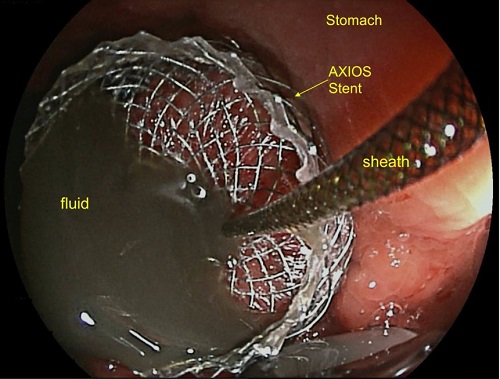 Endoscopic Ultrasound guided drainage of large walled off pancreatic necrosis (Pseudocyst with solid necrosis) with metallic AXIOS stent 03