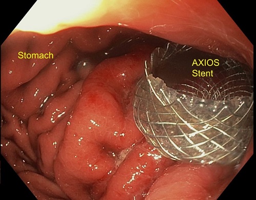 Endoscopic Ultrasound guided drainage of large walled off pancreatic necrosis (Pseudocyst with solid necrosis) with metallic AXIOS stent 04