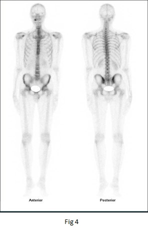 Fibrous Dysplasia in Maxillary Bone: Case Report