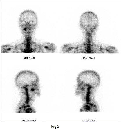 Fibrous Dysplasia in Maxillary Bone: Case Report