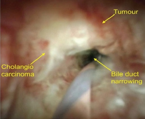 First ever Cholangioscopy (Endoscopy inside the bile duct) at Al Zahra Hospital, Sharjah 03