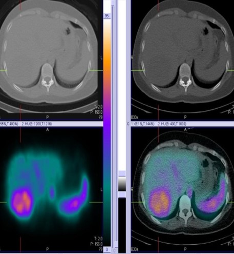 HEPATIC HEMANGIOMAS- THE ROLE OF 99mtc RBC LEBELLED LIVER BLOOD POOL SCINTIGRAPHY (STATIC AND SPECT-CT HYBRID IMAGING” by Dr Shekar Shikare, HOD & Consultant, Nuclear Medicine