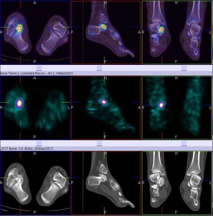 Hybrid Bone SPECT/CT imaging of the Foot and Ankle: Potential Clinical Applications in Foot Pain 03