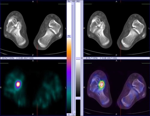 Hybrid Bone SPECT/CT imaging of the Foot and Ankle: Potential Clinical Applications in Foot Pain 04
