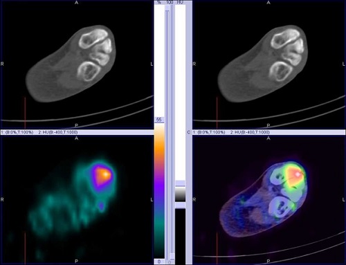 Hybrid Bone SPECT/CT imaging of the Foot and Ankle: Potential Clinical Applications in Foot Pain 05