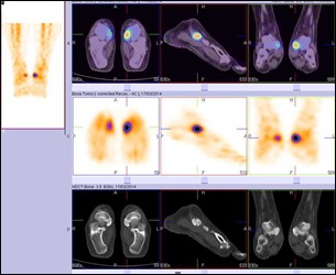 Hybrid Bone SPECT/CT imaging of the Foot and Ankle: Potential Clinical Applications in Foot Pain 08