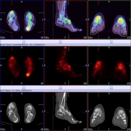 Hybrid Bone SPECT/CT imaging of the Foot and Ankle: Potential Clinical Applications in Foot Pain by Dr Shekar Shikare, HOD & Consultant, Nuclear Medicine, NMC Royal Hospital Sharjah