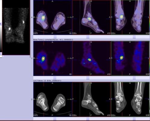Hybrid Bone SPECT/CT imaging of the Foot and Ankle: Potential Clinical Applications in Foot Pain by Dr Shekar Shikare, HOD & Consultant, Nuclear Medicine, NMC Royal Hospital Sharjah