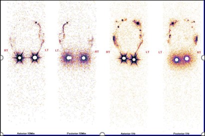 Lymphoedema after breast cancer treatment. The role of upper limb lympho-scintigraphy 06