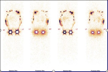 Lymphoedema after breast cancer treatment. The role of upper limb lympho-scintigraphy 07