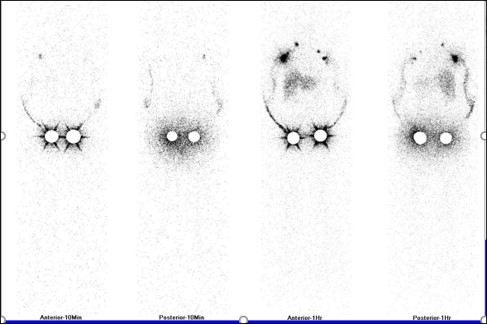 Lymphoedema after breast cancer treatment. The role of upper limb lympho-scintigraphy 08